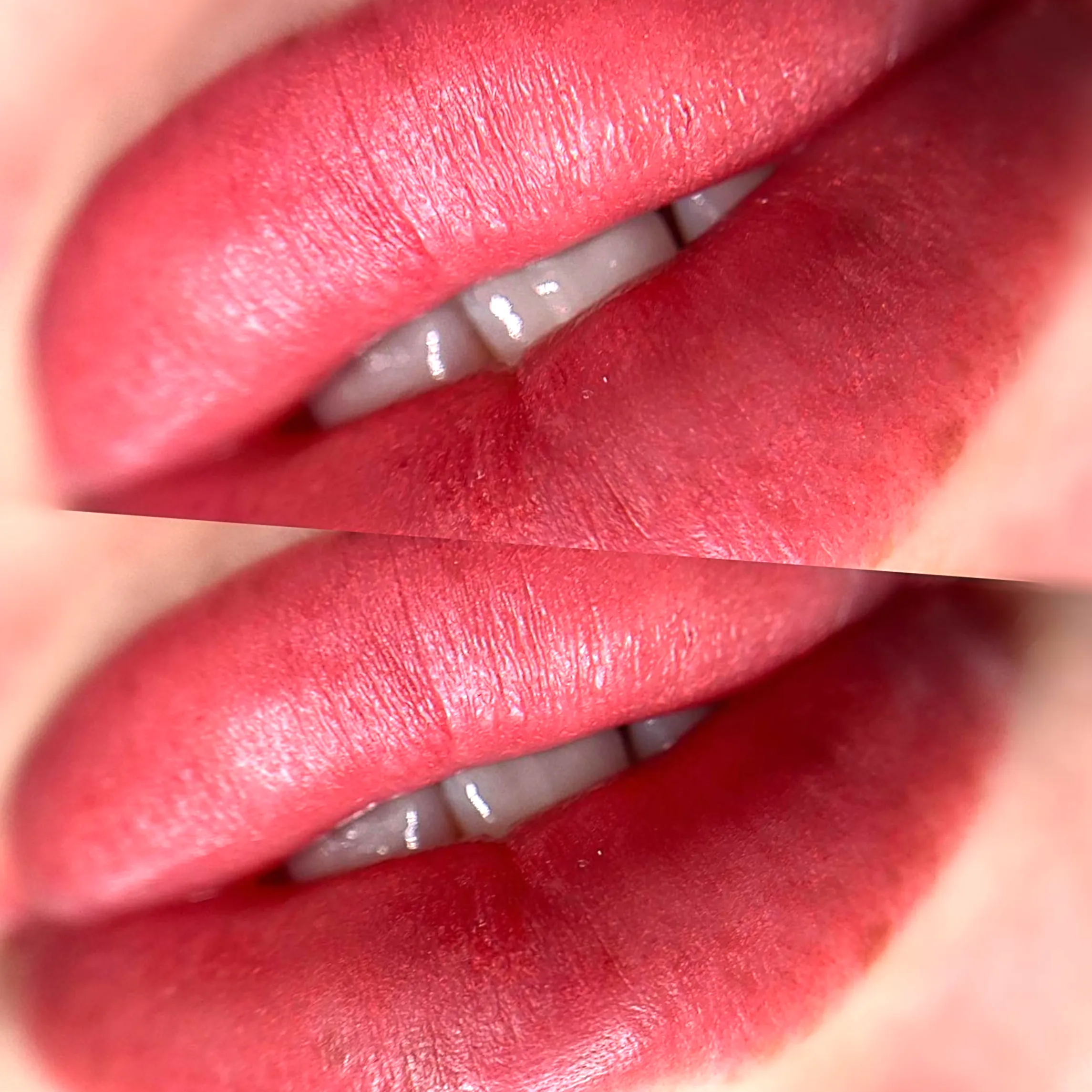 lip blush and dermal fillers
