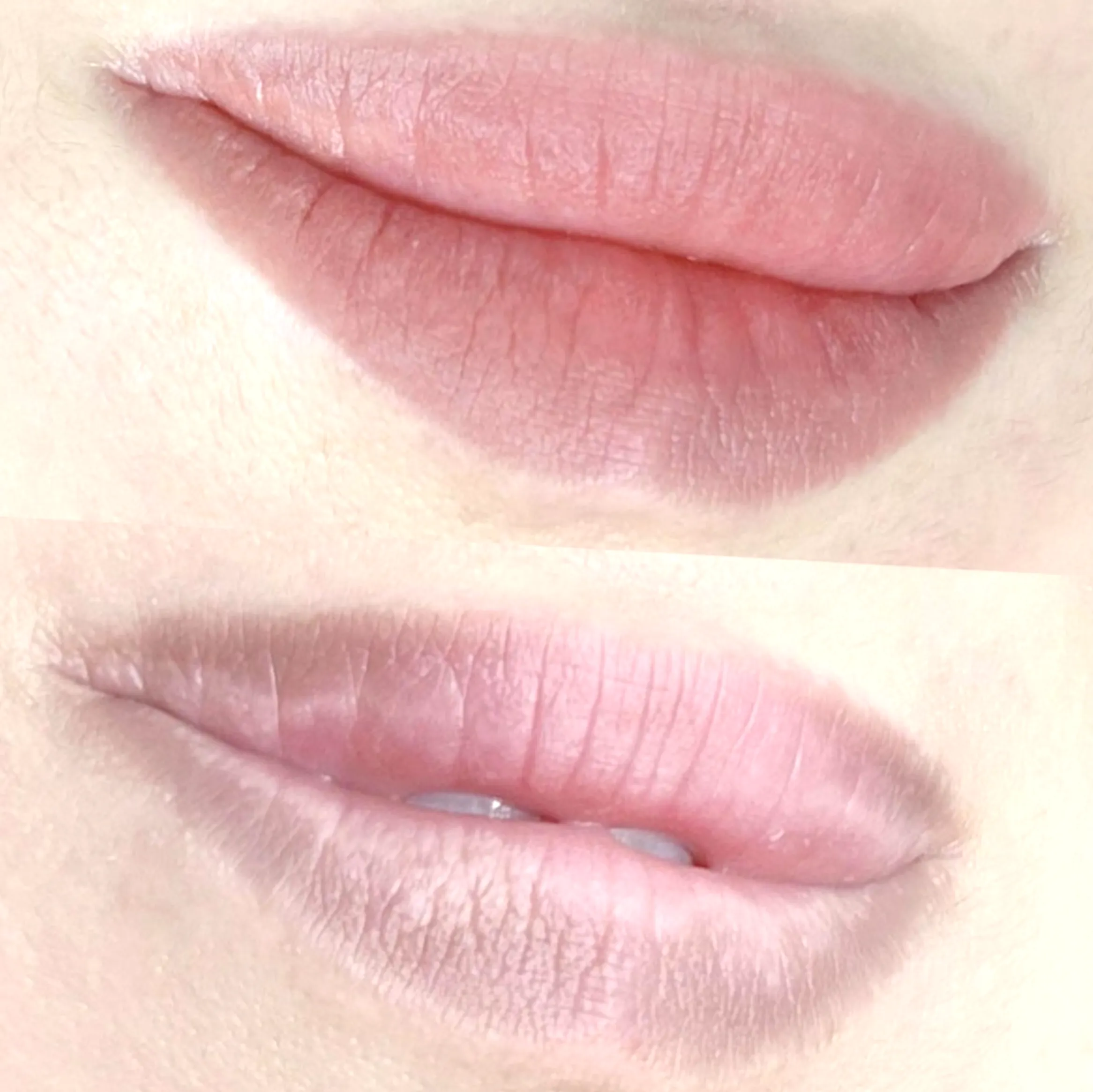 can you get lip tattoo after fillers